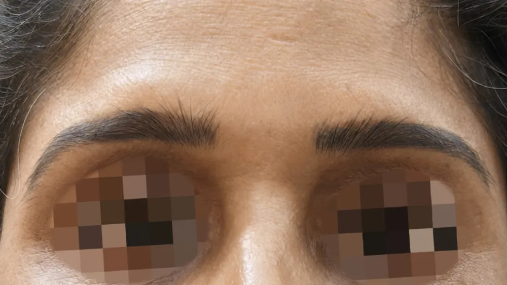 Brow Lift — before