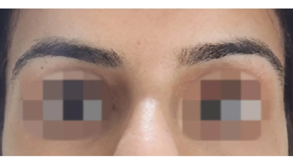 Brow Lift — after