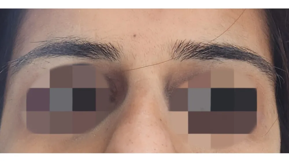Brow Lift — before