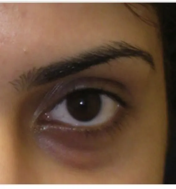 Dark Circles Treatment — before