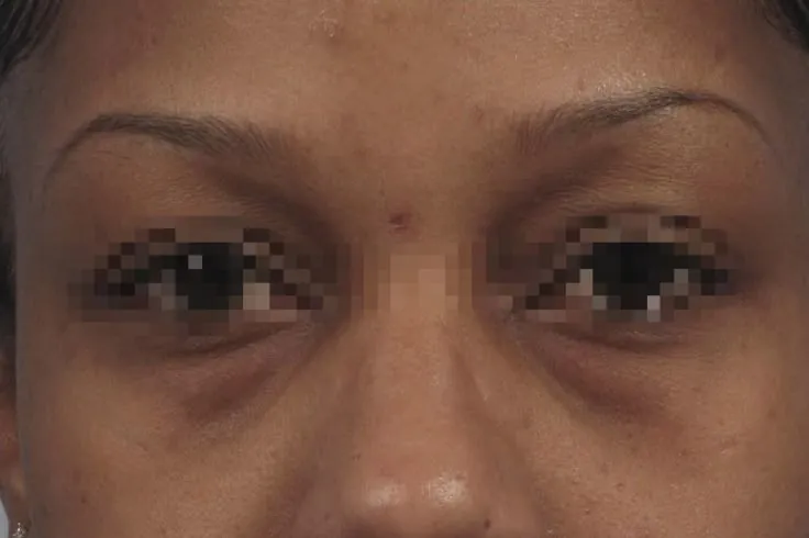 Dark Circles Treatment — before