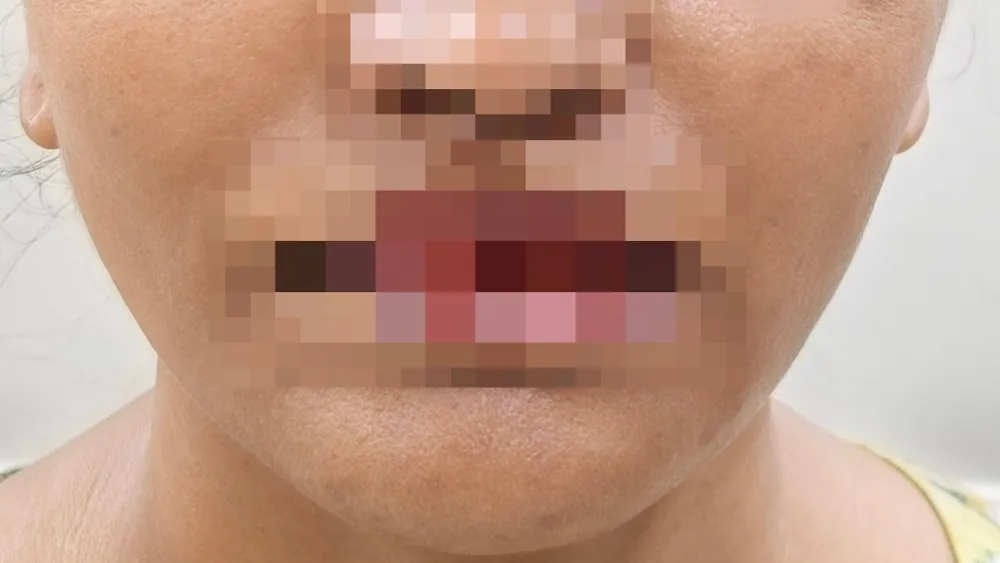 Face Lift — after