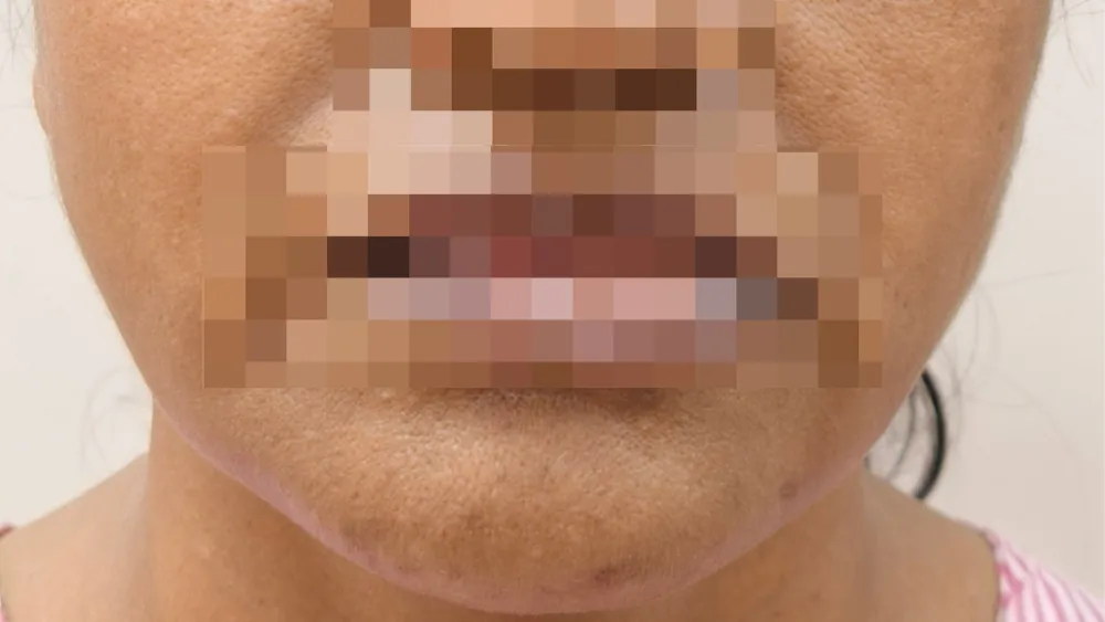 Face Lift — before