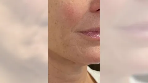 Facial Rejuvenation — after