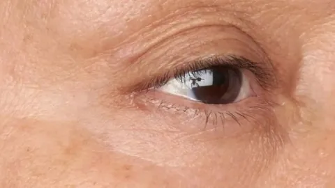 Facial Wrinkles — after