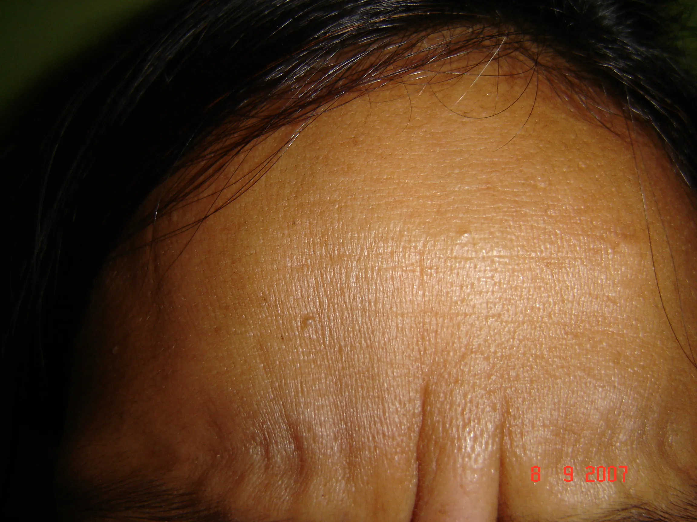 Facial Wrinkles — before