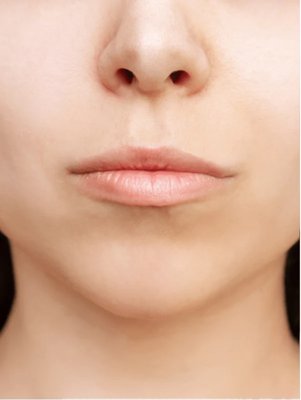 Lip Augmentation — procedure visual