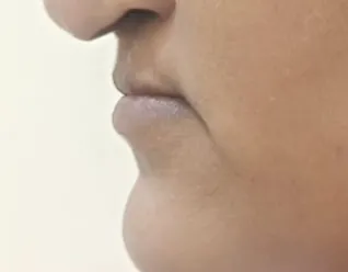 Lip Augmentation — before