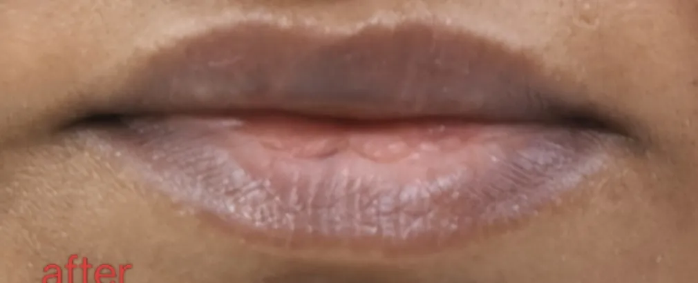 Lip Augmentation — after