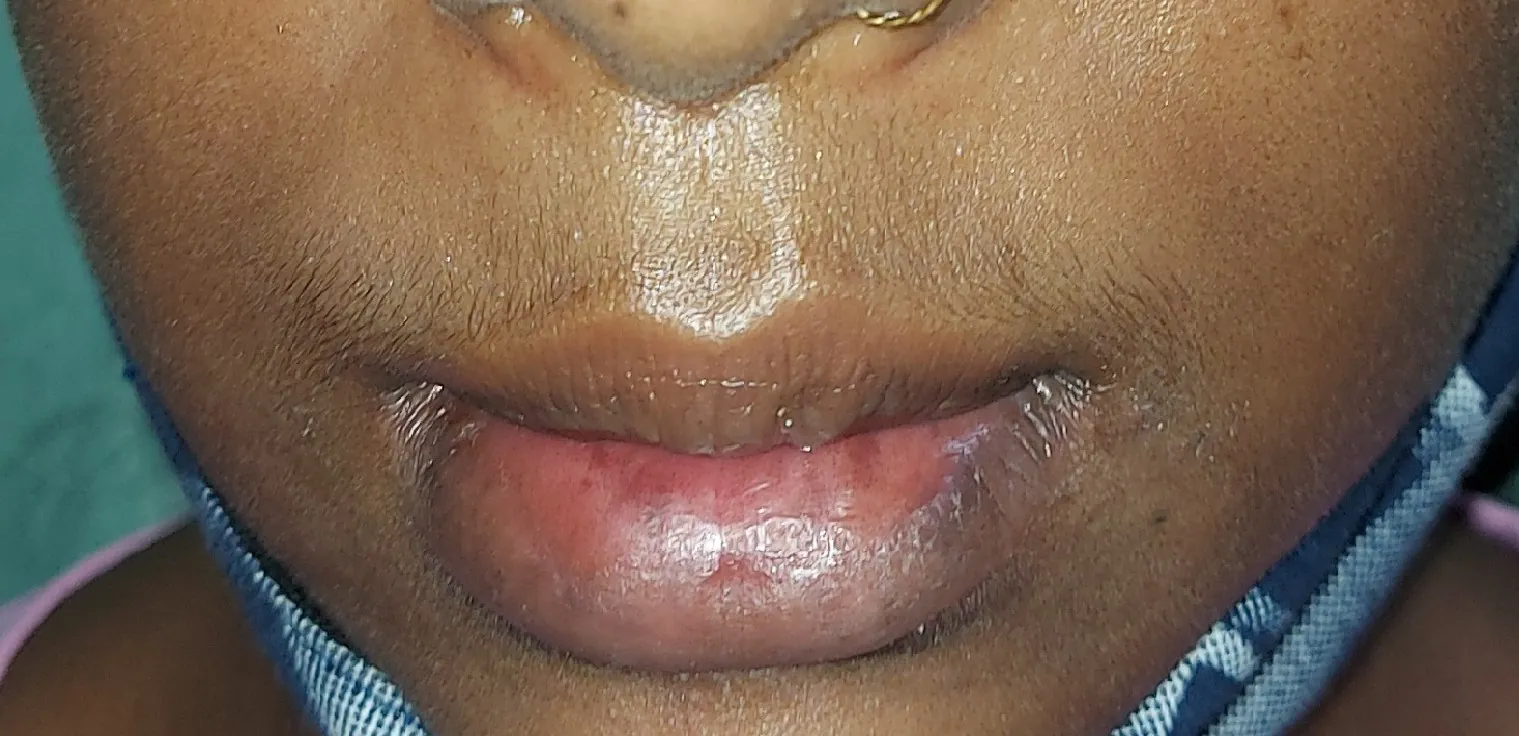 Lip Reduction — before