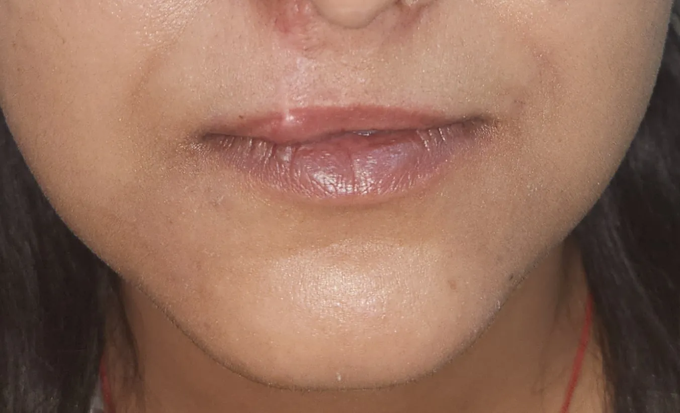 Upper Lip Lift — before