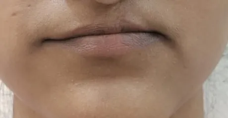 Upper Lip Lift — before