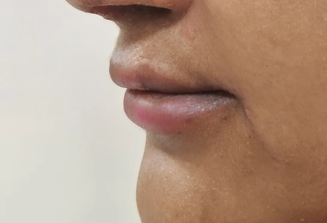 Upper Lip Lift — after