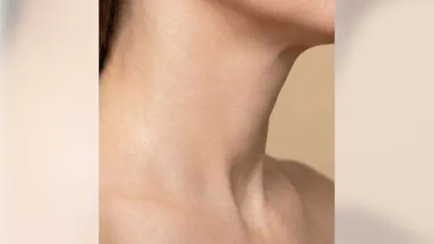 Neck Lift — after
