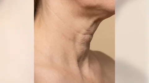 Neck Lift — before