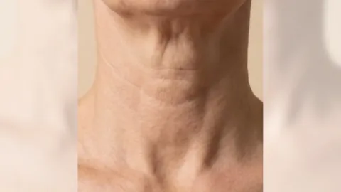 Neck Lift — before
