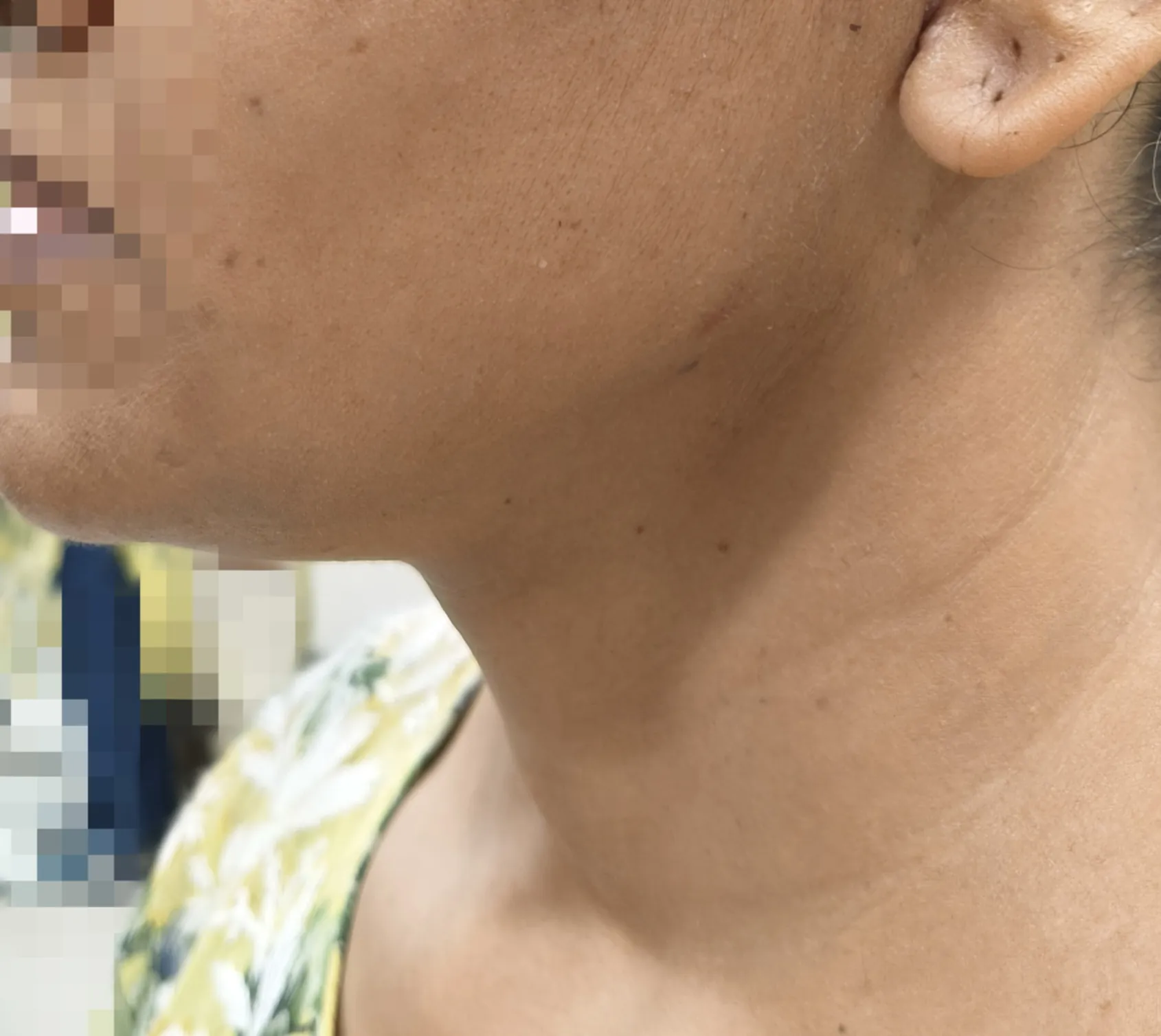 Neck Liposuction — after