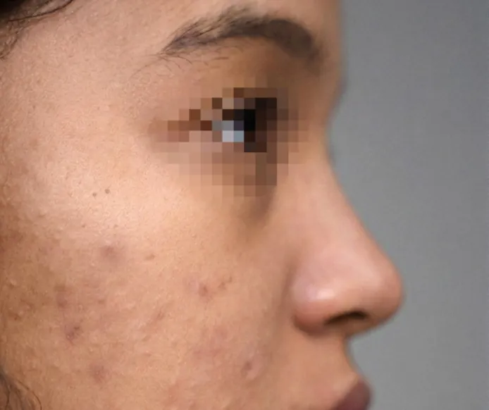 Non Surgical Rhinoplasty — before