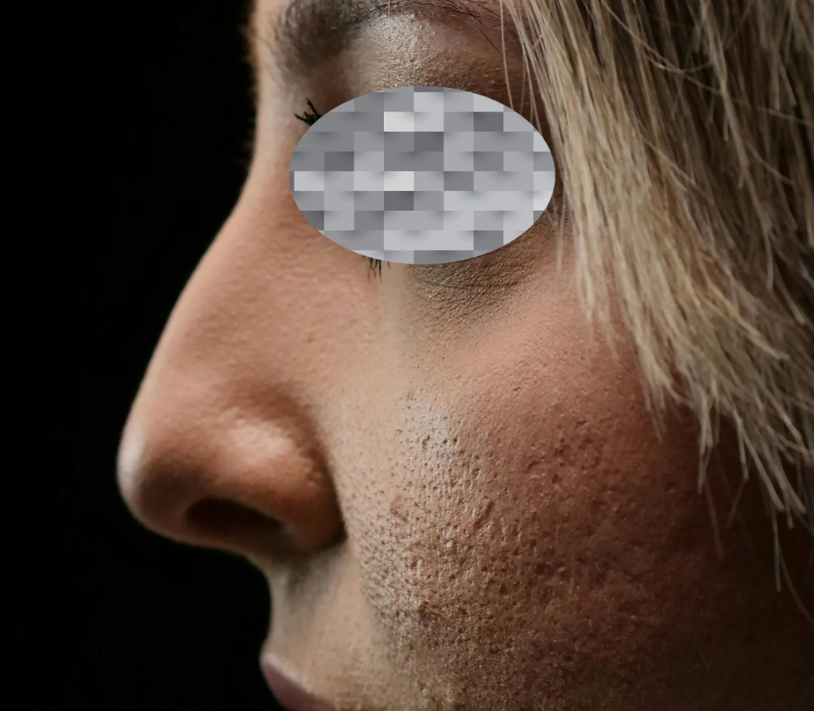 Non Surgical Rhinoplasty — before