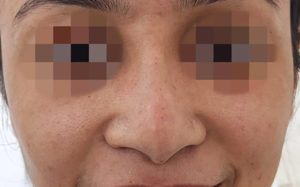 Non Surgical Rhinoplasty — before