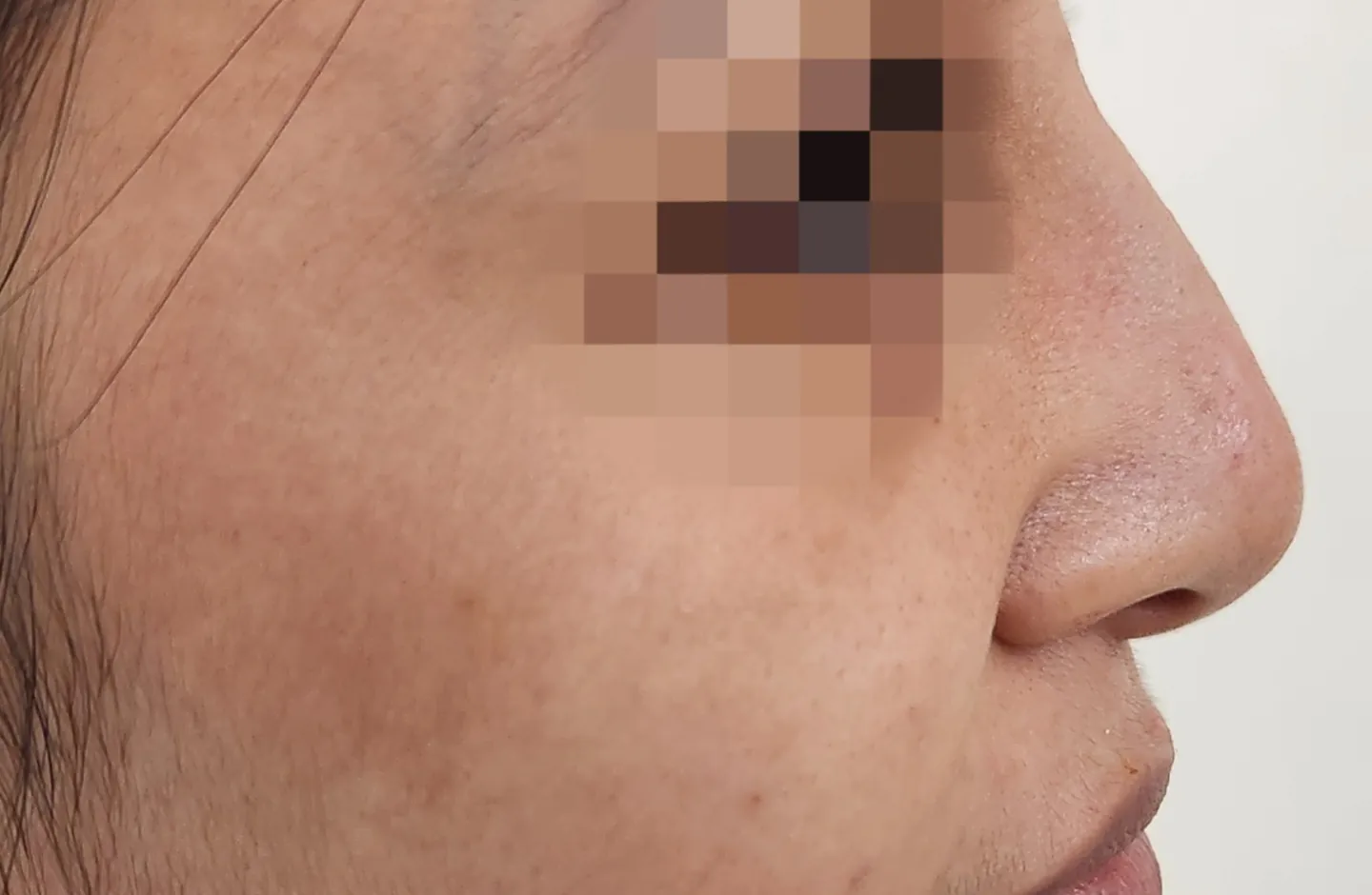 Non Surgical Rhinoplasty — before