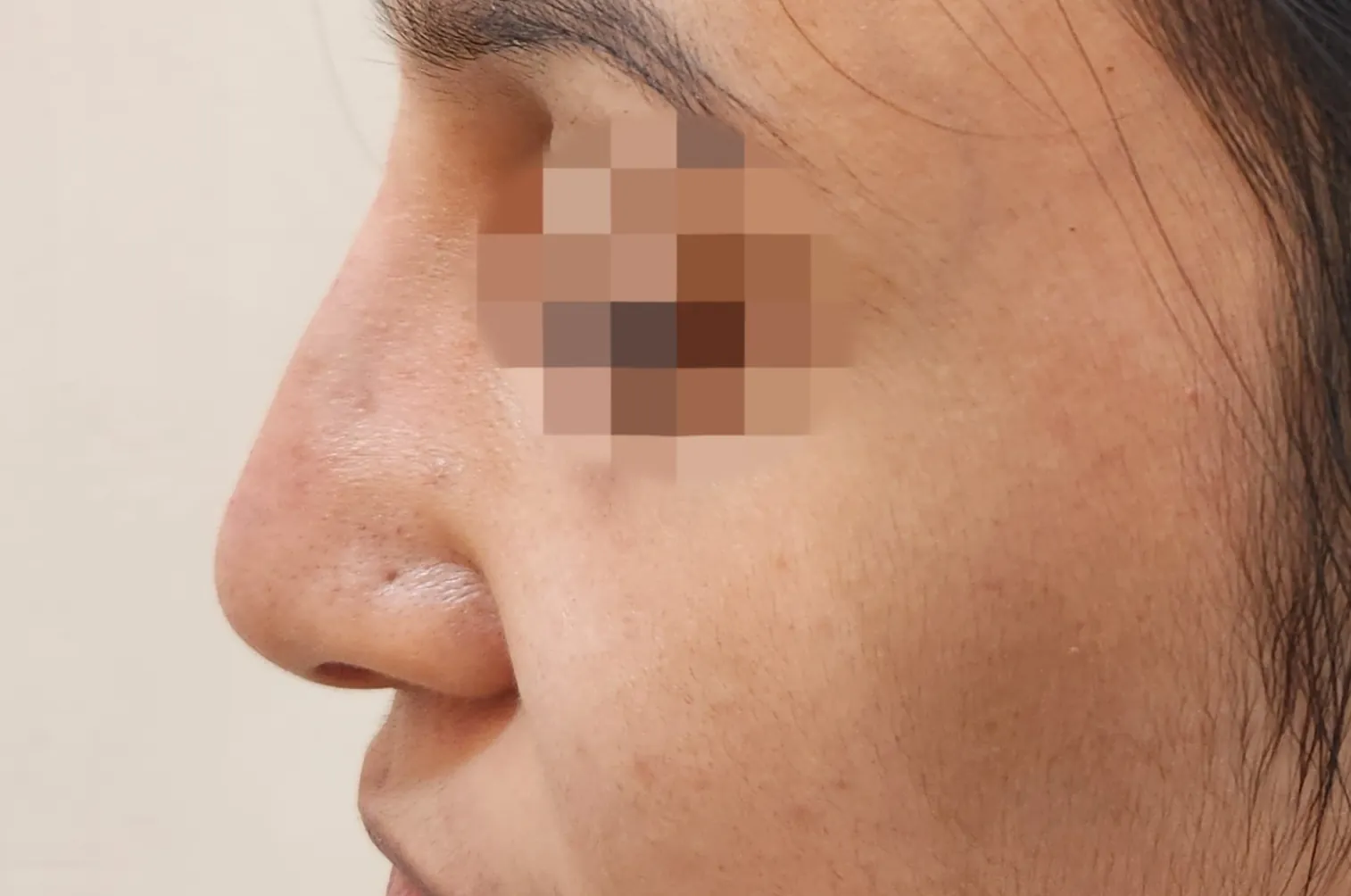 Non Surgical Rhinoplasty — before