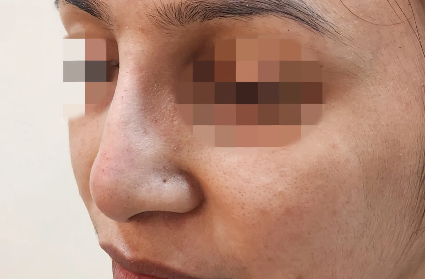 Non Surgical Rhinoplasty — before