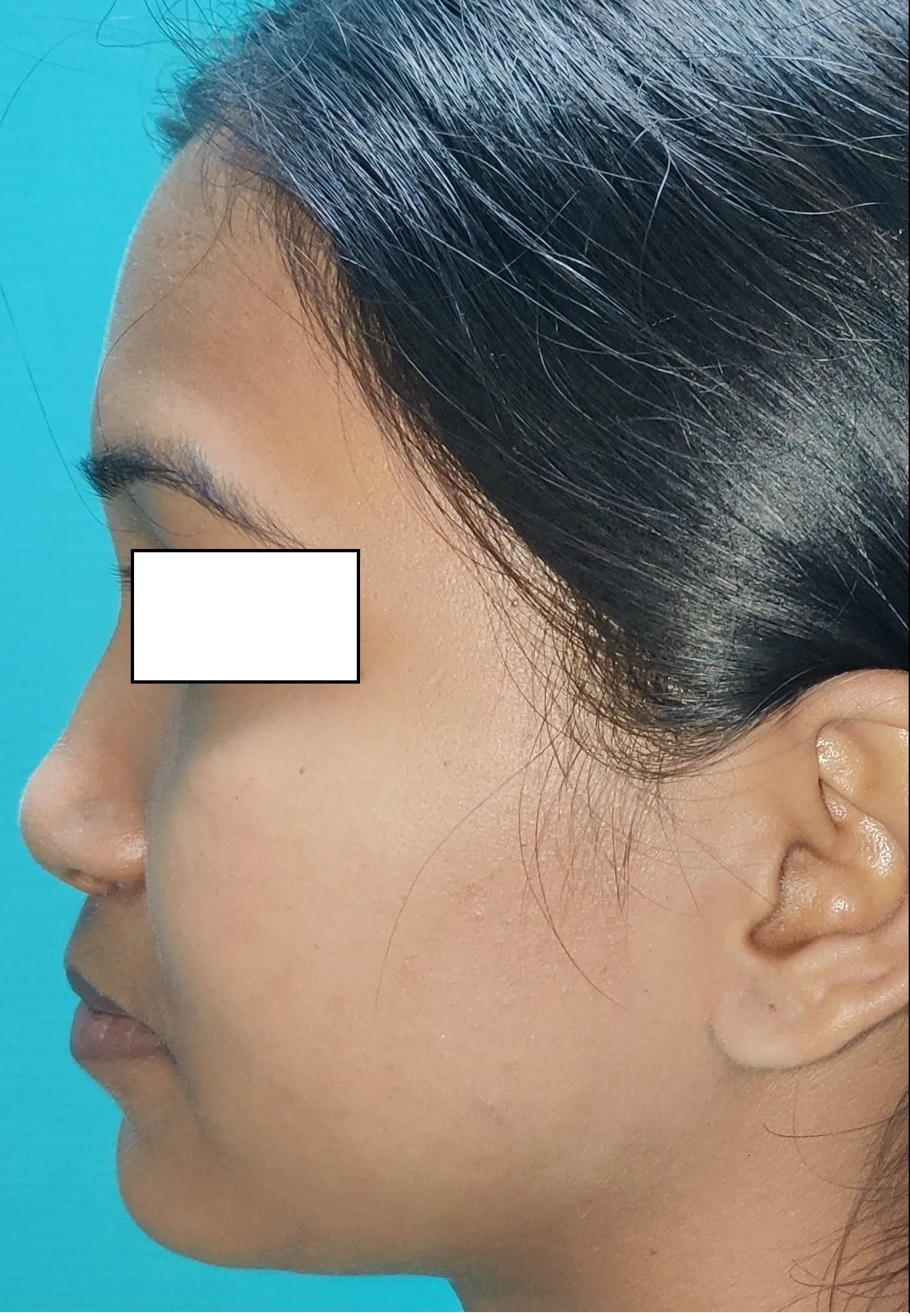 Rhinoplasty — before