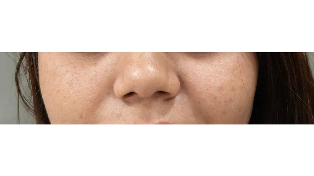 Rhinoplasty — before