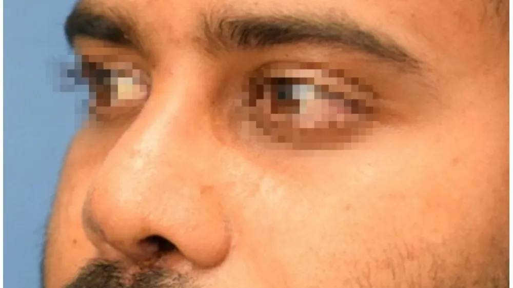 Rhinoplasty — after
