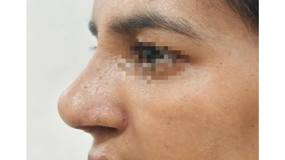 Rhinoplasty — after