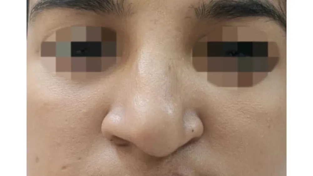 Rhinoplasty — before