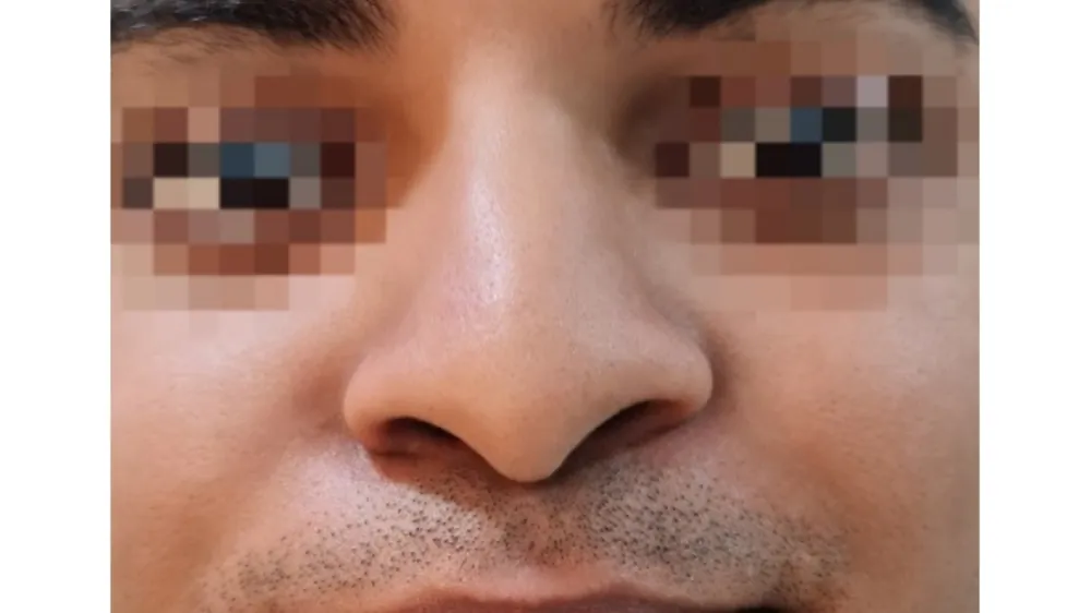 Rhinoplasty — before
