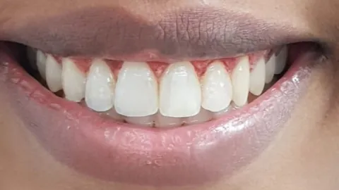 Gummy Smile Correction — after