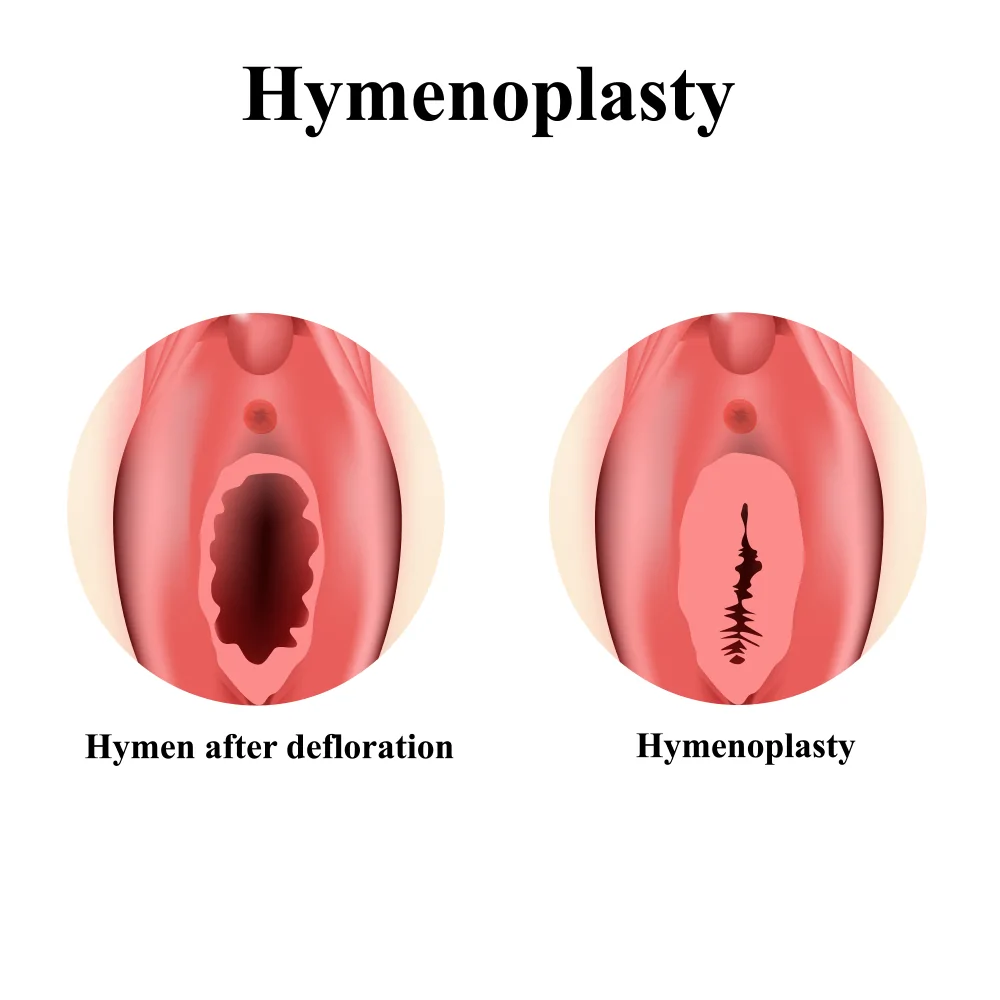 Hymenoplasty — hero image