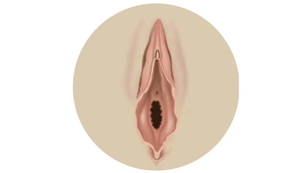 Hymenoplasty — before