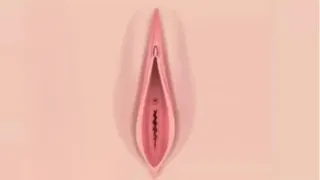 Labiaplasty — after