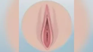 Labiaplasty — after