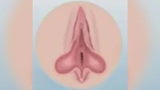 Labiaplasty — before