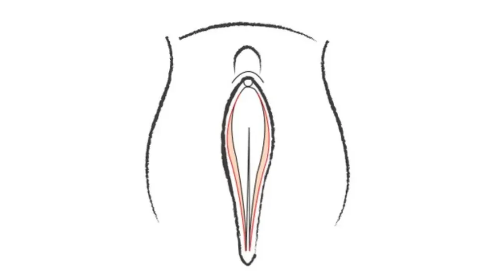 Vaginoplasty — after
