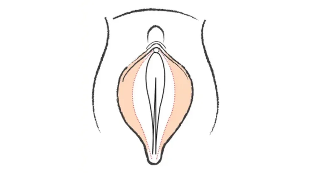 Vaginoplasty — before