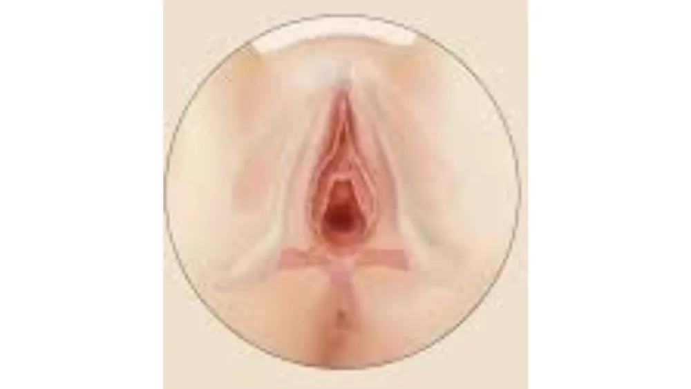 Vaginoplasty — before