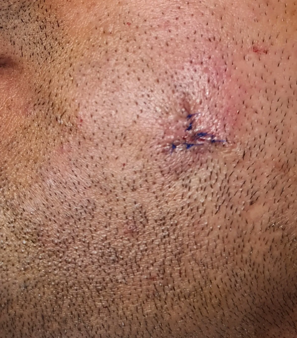 Mole Excision — after