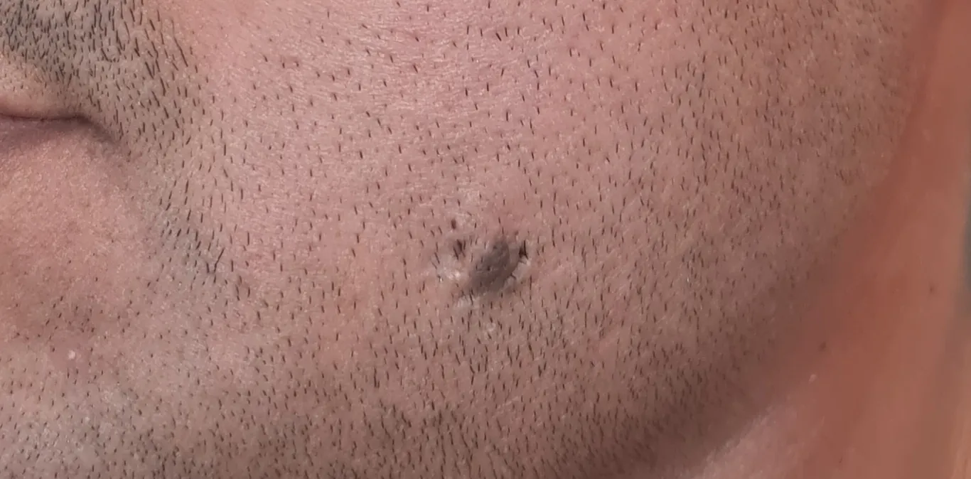 Mole Excision — before