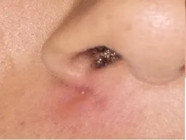 Mole Excision — after
