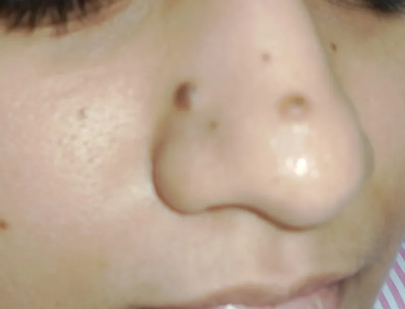 Mole Excision — before
