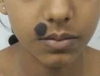 Mole Excision — before