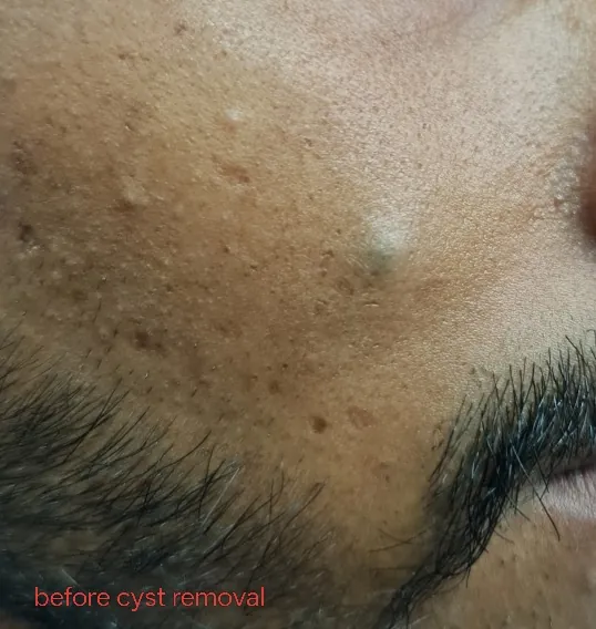 Mole Excision — before