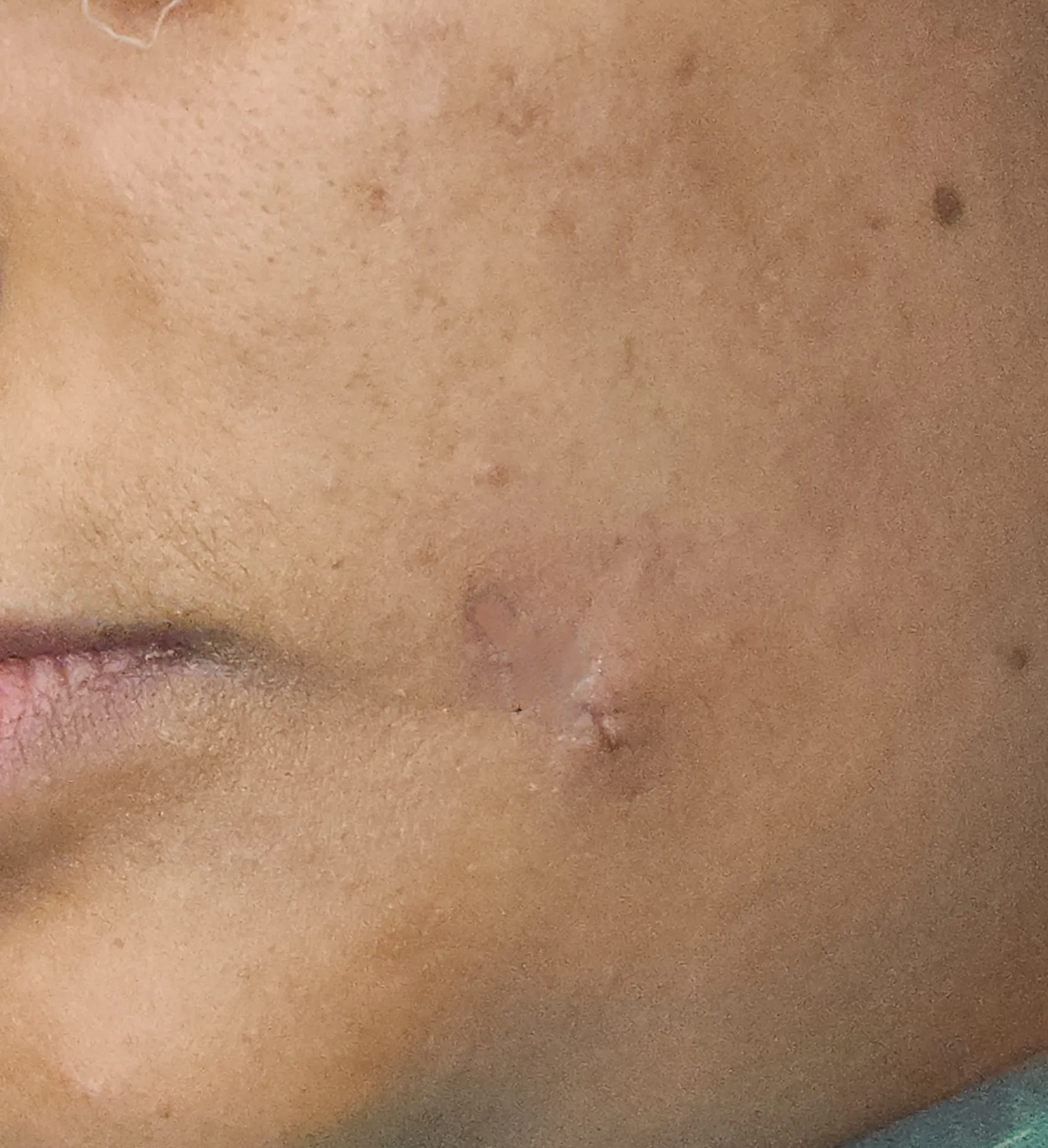 Mole Excision — after