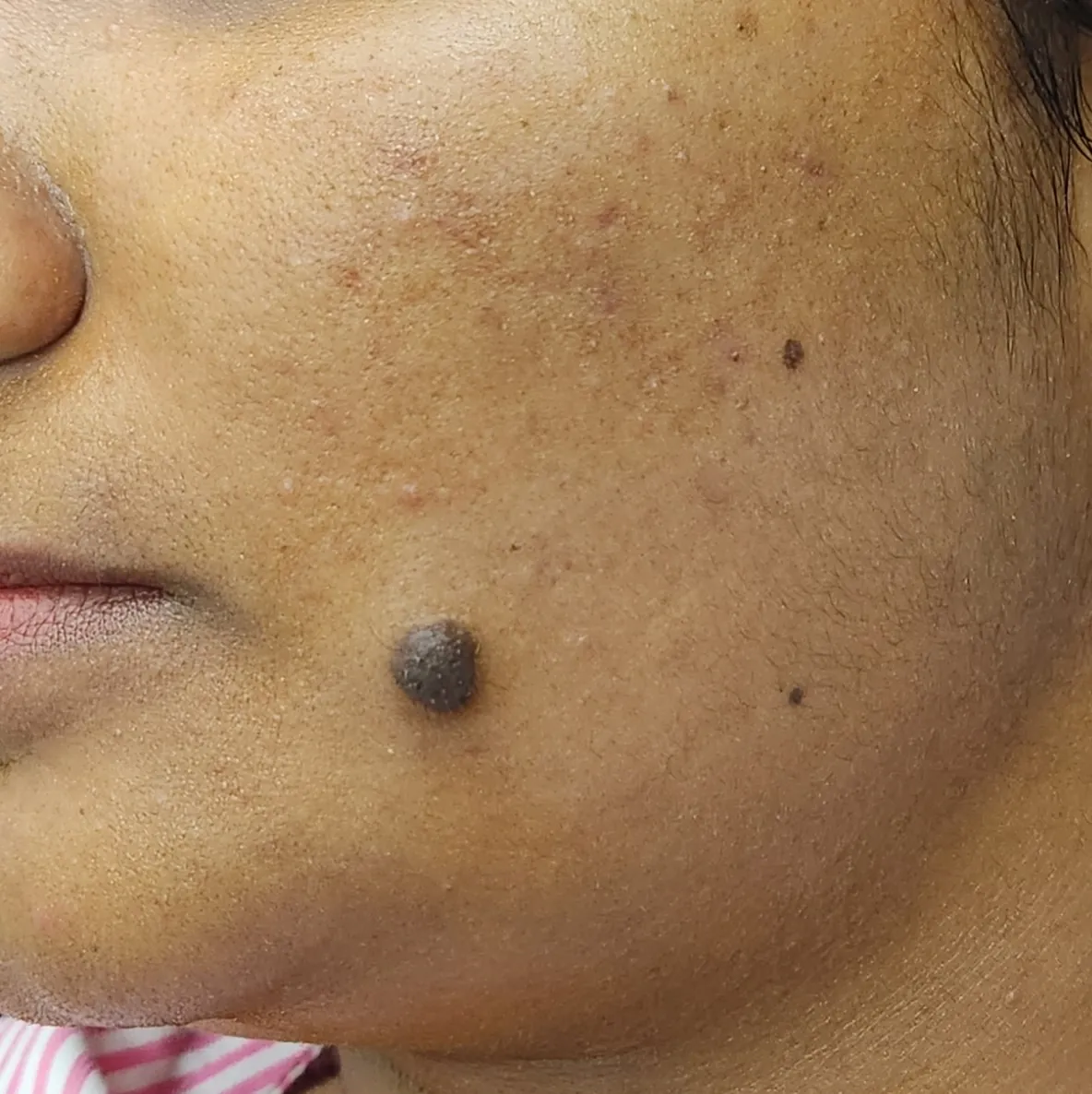 Mole Excision — before